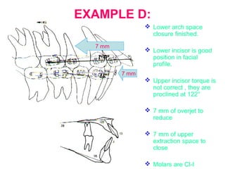 EXAMPLE D: 
 Lower arch space 
closure finished. 
 Lower incisor is good 
position in facial 
profile. 
 Upper incisor torque is 
not correct , they are 
proclined at 122° 
 7 mm of overjet to 
reduce 
 7 mm of upper 
extraction space to 
close 
 Molars are Cl-I 
7 mm 
7 mm 
 