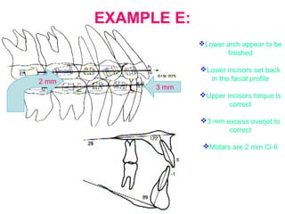 EXAMPLE E: 
Lower arch appear to be 
finished 
Lower incisors set back 
in the facial profile 
Upper incisors torque is 
correct 
3 mm excess overjet to 
correct 
Molars are 2 mm Cl-II 
3 mm 
2 mm 
 