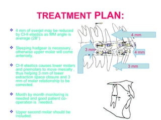 TREATMENT PLAN: 
 4 mm of overjet may be reduced 
by Cl-II elastics as MM angle is 
average (28°) 
 Sleeping hadgear is necessary , 
otherwise upper molar will come 
anteriorly. 
 Cl-II elastics causes lower molars 
and premolars to move mesially , 
thus helping 3 mm of lower 
extraction space closure and 3 
mm of molar relationship to be 
corrected. 
 Month by month monitoring is 
needed and good patient co-operation 
is needed. 
 Upper second molar should be 
included. 
4 mm 
4 mm 
3 mm 
3 mm 
 