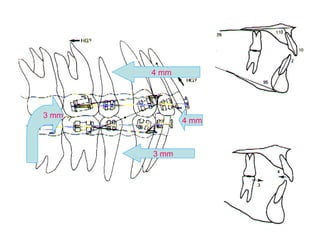 4 mm 
4 mm 
3 mm 
3 mm 
 