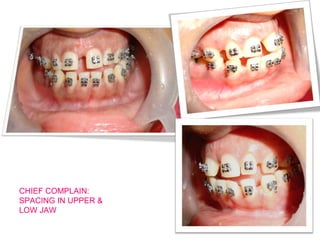 CHIEF COMPLAIN: 
SPACING IN UPPER & 
LOW JAW 
 