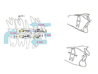 4 mm 
4 mm 
4 mm 
4 mm 
 