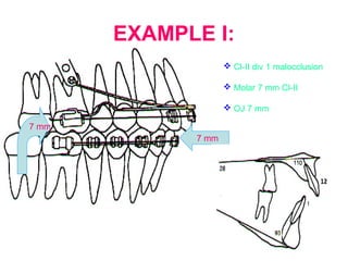 EXAMPLE I: 
 Cl-II div 1 malocclusion 
 Molar 7 mm Cl-II 
 OJ 7 mm 
7 mm 
7 mm 
 