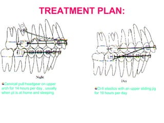 TREATMENT PLAN: 
Cervical pull headgear on upper 
arch for 14 hours per day , usually 
when pt is at home and sleeping 
Cl-II elastics with an upper sliding jig 
for 10 hours per day 
 