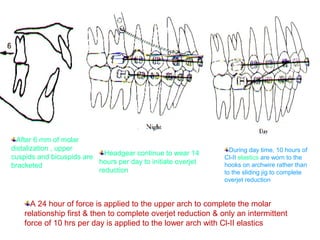 After 6 mm of molar 
distalization , upper 
cuspids and bicuspids are 
bracketed 
Headgear continue to wear 14 
hours per day to initiate overjet 
reduction 
During day time, 10 hours of 
Cl-II elastics are worn to the 
hooks on archwire rather than 
to the sliding jig to complete 
overjet reduction 
A 24 hour of force is applied to the upper arch to complete the molar 
relationship first & then to complete overjet reduction & only an intermittent 
force of 10 hrs per day is applied to the lower arch with Cl-II elastics 
 
