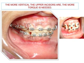 THE MORE VERTICAL THE UPPER INCISORS ARE, THE MORE 
TORQUE IS NEEDED. 
 