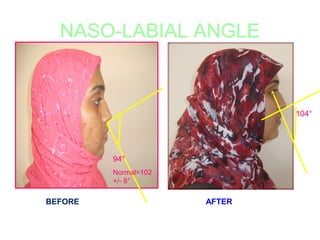 NASO-LABIAL ANGLE 
94° 
Normal=102 
+/- 8° 
104° 
BEFORE AFTER 
 