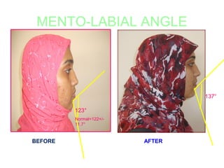 MENTO-LABIAL ANGLE 
137° 
123° 
Normal=122+/- 
11.7° 
BEFORE AFTER 
 