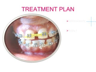 TREATMENT PLAN 
APPROXIMATE 12 12 
12 12 
THEN ? 
 