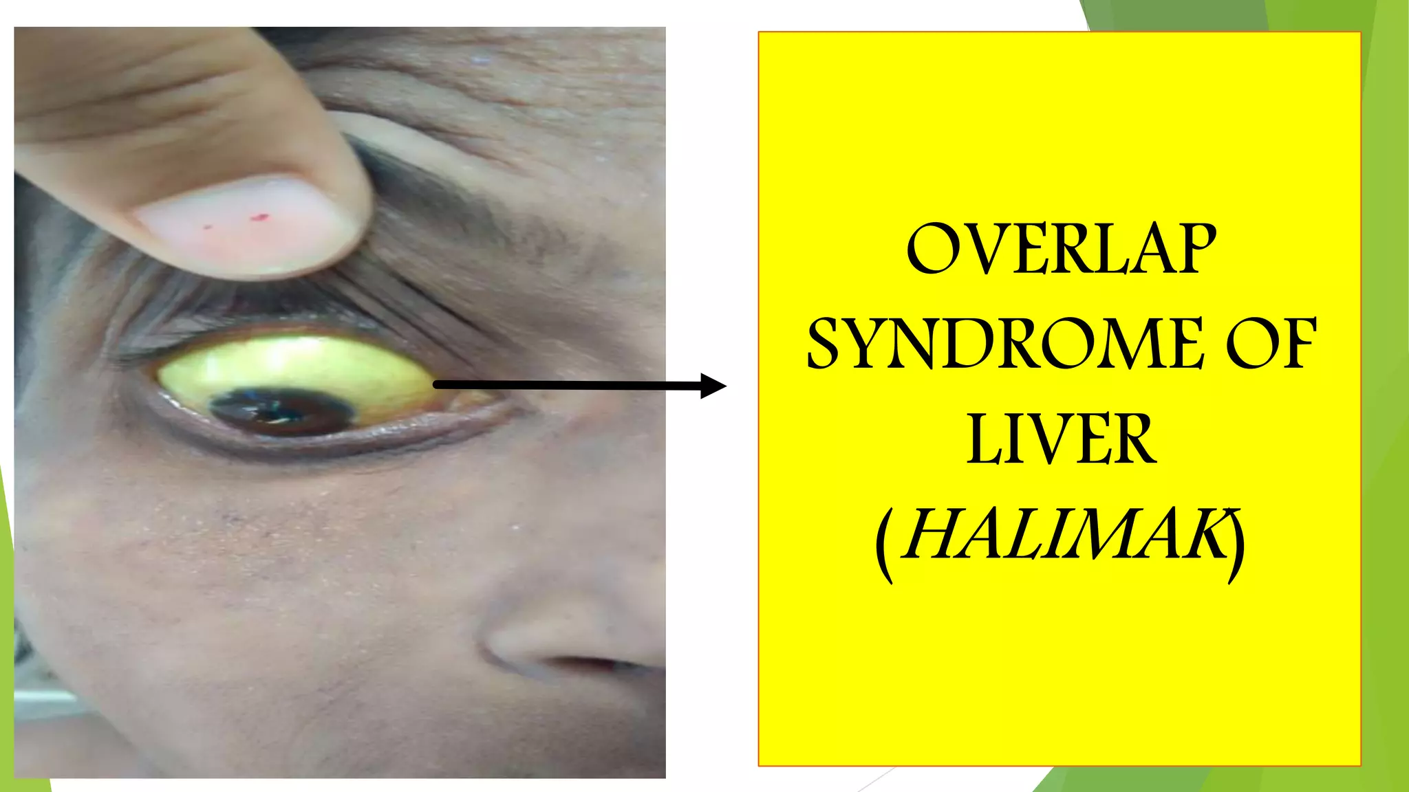 Overlap syndrome | PPTX | Blood Disorders | Diseases and Conditions