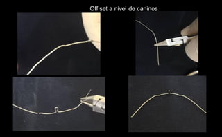 Off set a nivel de caninos
 