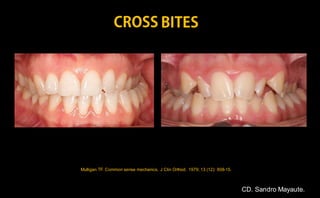 Mulligan TF. Common sense mechanics. J Clin Orthod. 1979; 13 (12): 808-15.
CD. Sandro Mayaute.
 