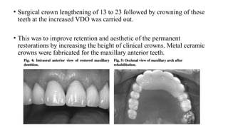 Overlay Temporary Denture Overlay Removable Partial Dentures in Prosthodontics | PPTX