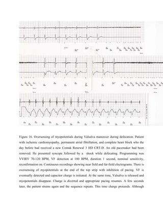Myopotentials Oversensing In Is | PDF