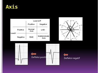 Defleksi positif   Defleksi negatif
 