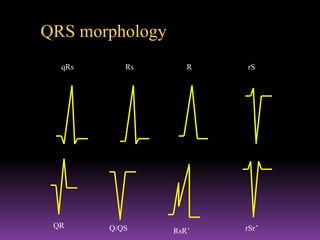 QRS morphology
  qRs      Rs       R   rS




 QR     Q/QS            rSr’
                 RsR’
 