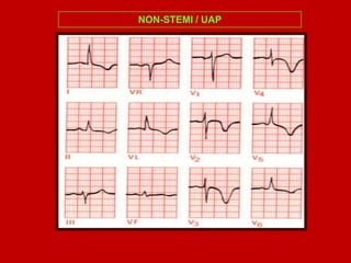 NON-STEMI / UAP
 