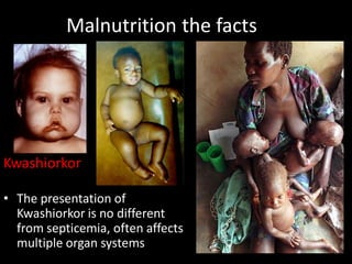 Malnutrition the facts
• The presentation of
Kwashiorkor is no different
from septicemia, often affects
multiple organ systems
Kwashiorkor
 