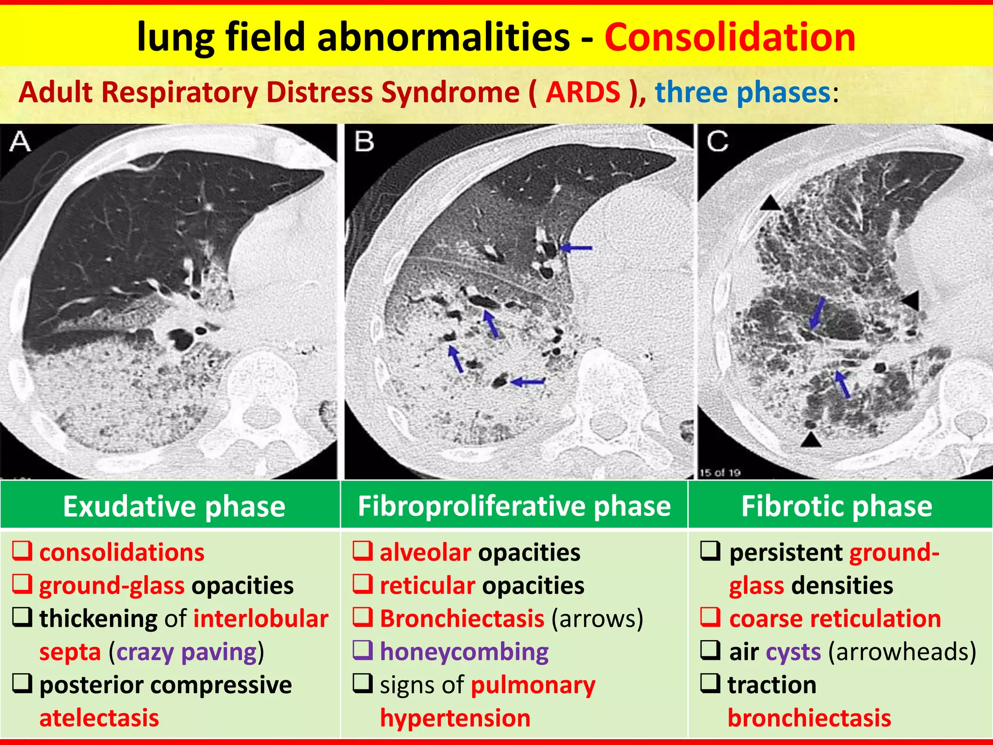 Overview of community-acquired pneumonia in adults.pdf