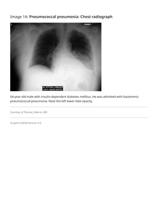 Overview of community-acquired pneumonia in adults - UpToDate.pdf