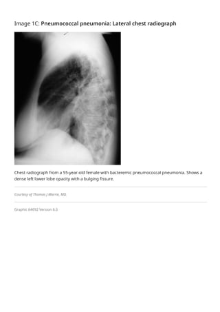 Overview of community-acquired pneumonia in adults - UpToDate.pdf