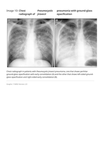Overview of community-acquired pneumonia in adults - UpToDate.pdf
