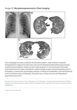 Overview of community-acquired pneumonia in adults - UpToDate.pdf