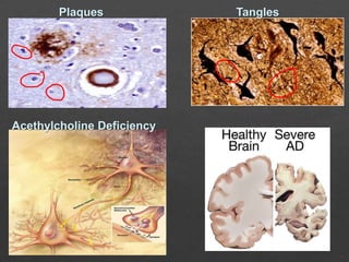 Plaques

Acethylcholine Deficiency

Tangles

 