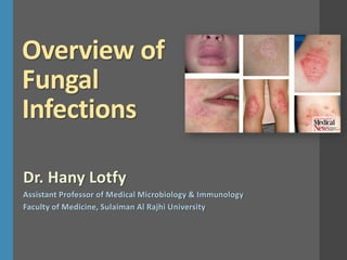 Overview of
Fungal
Infections
Dr. Hany Lotfy
Assistant Professor of Medical Microbiology & Immunology
Faculty of Medicine, Sulaiman Al Rajhi University
 