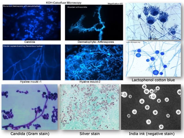 Overview of Fungal Infections | PDF | Skin and Dermatology | Diseases ...