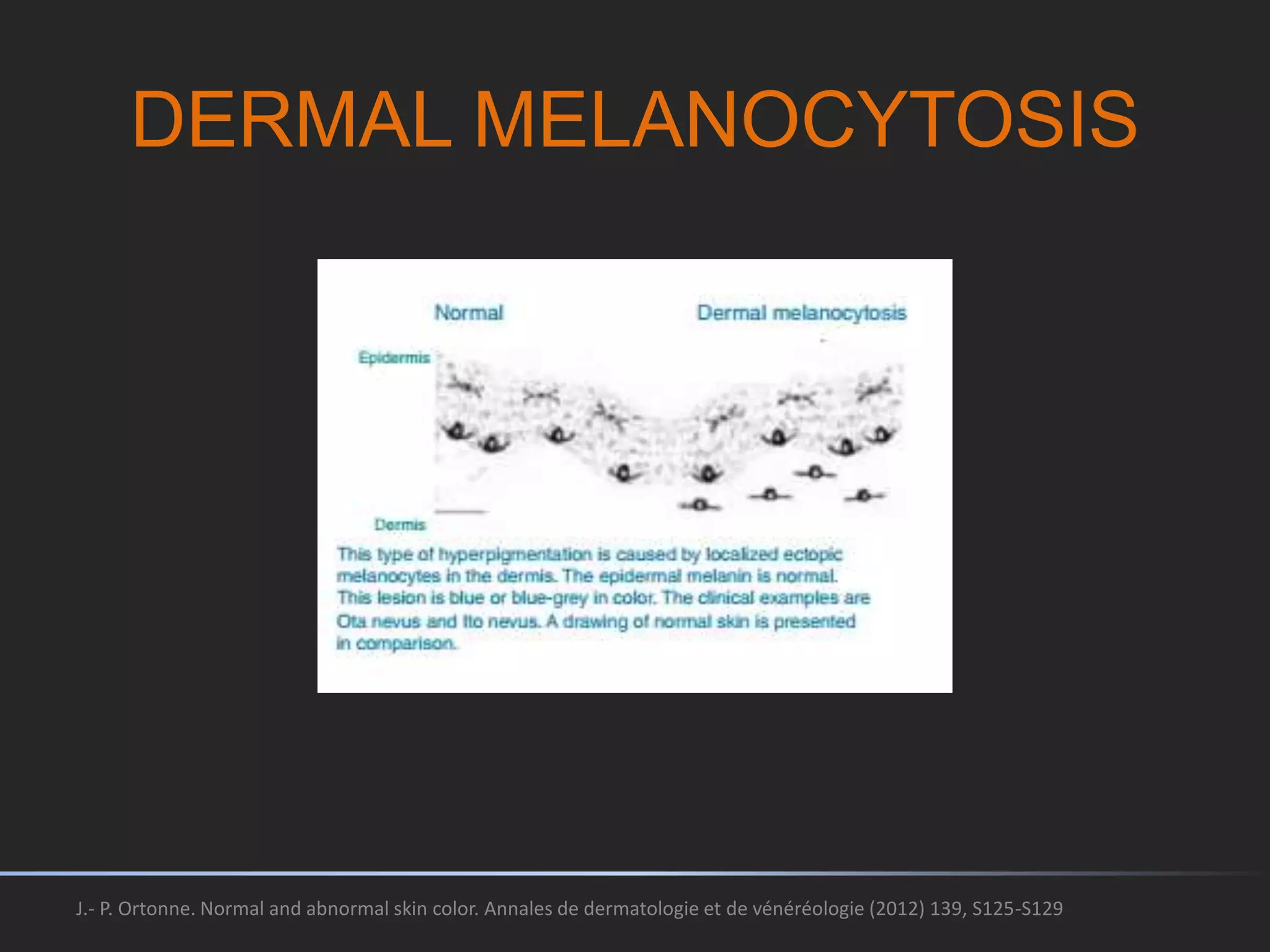 Melanoderma Overview of hyperpigmentation disorders | PPTX