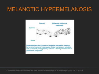 MELANOTIC HYPERMELANOSIS
J.- P. Ortonne. Normal and abnormal skin color. Annales de dermatologie et de vénéréologie (2012) 139, S125-S129
 