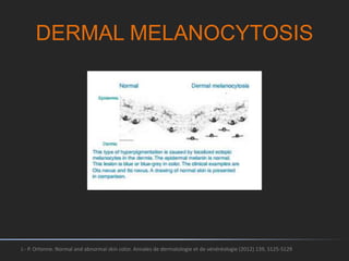 DERMAL MELANOCYTOSIS
J.- P. Ortonne. Normal and abnormal skin color. Annales de dermatologie et de vénéréologie (2012) 139, S125-S129
 