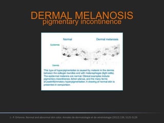 DERMAL MELANOSIS
J.- P. Ortonne. Normal and abnormal skin color. Annales de dermatologie et de vénéréologie (2012) 139, S125-S129
pigmentary incontinence
 