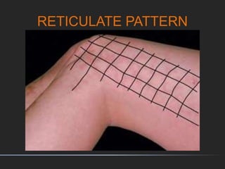 RETICULATE PATTERN
 