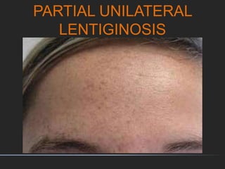 PARTIAL UNILATERAL
LENTIGINOSIS
 