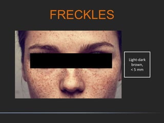 FRECKLES
Light-dark
brown,
< 5 mm
 