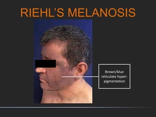 RIEHL’S MELANOSIS
Brown/blue
reticulate hyper-
pigmentation
 