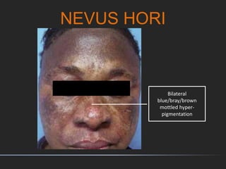 NEVUS HORI
Bilateral
blue/bray/brown
mottled hyper-
pigmentation
 