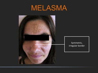 MELASMA
Symmetric,
irregular border
 
