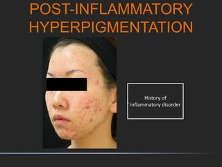 POST-INFLAMMATORY
HYPERPIGMENTATION
History of
inflammatory disorder
 