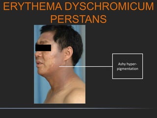 ERYTHEMA DYSCHROMICUM
PERSTANS
Ashy hyper-
pigmentation
 