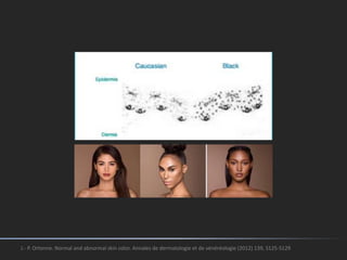 J.- P. Ortonne. Normal and abnormal skin color. Annales de dermatologie et de vénéréologie (2012) 139, S125-S129
 