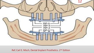 Overview of impression technique in implant dentistry.pptx
