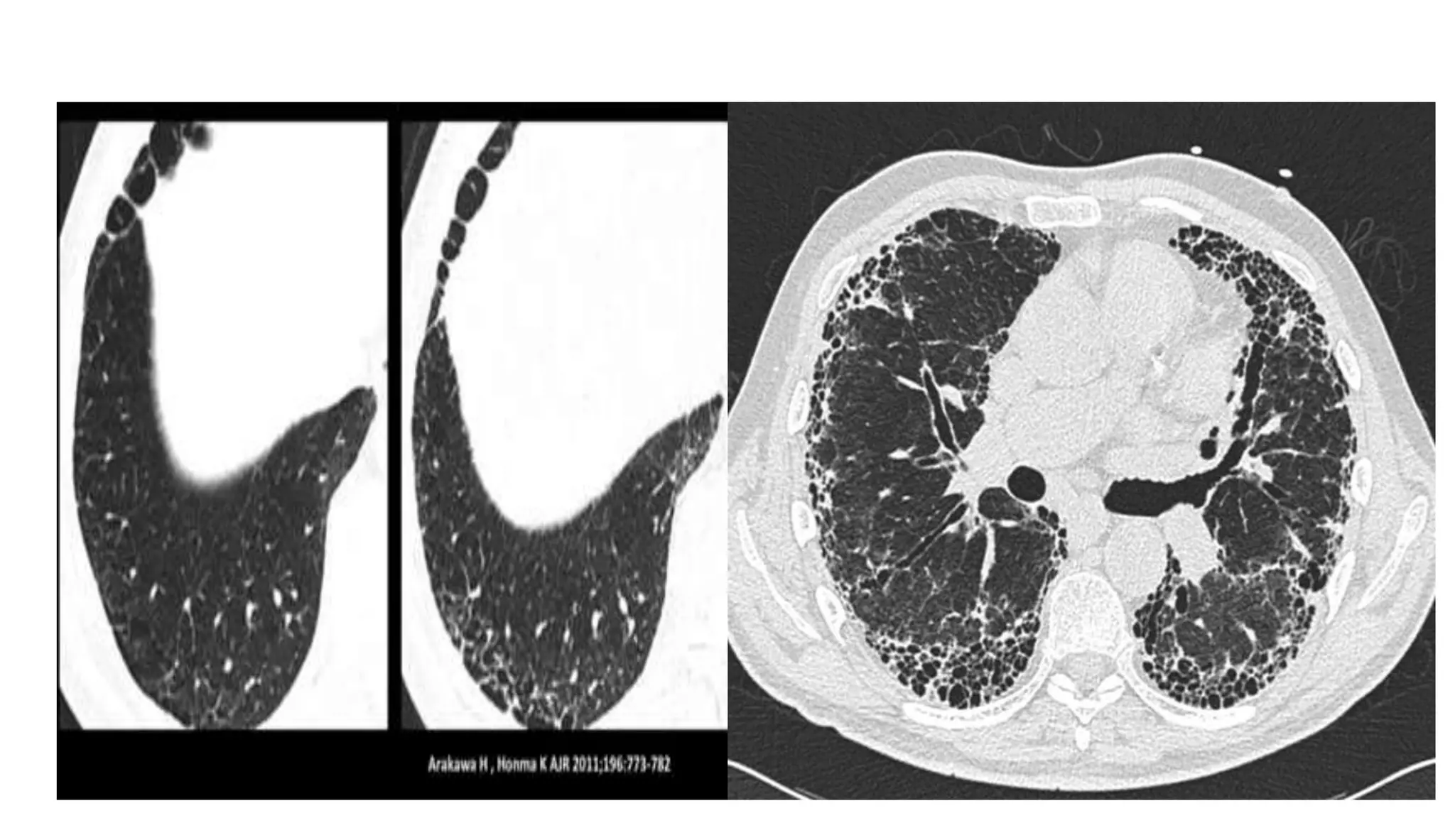 Overview of interstitial lung diseases | PPTX
