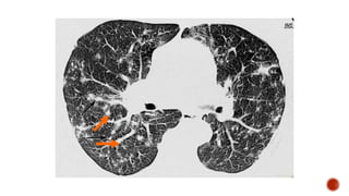 Overview of interstitial lung diseases | PPTX