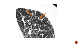 Overview of interstitial lung diseases | PPTX