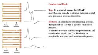 Myopathic and NMJ disorders
• Sensory conduction studies are always normal.
• Proximal myopathies: motor conduction studie...