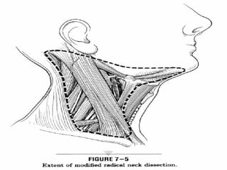 Neck Dissection Rcpa Overview Of Neck Dissections | PPT
