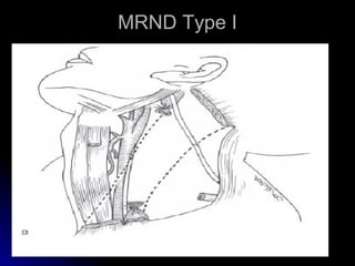 MRND Type I 
